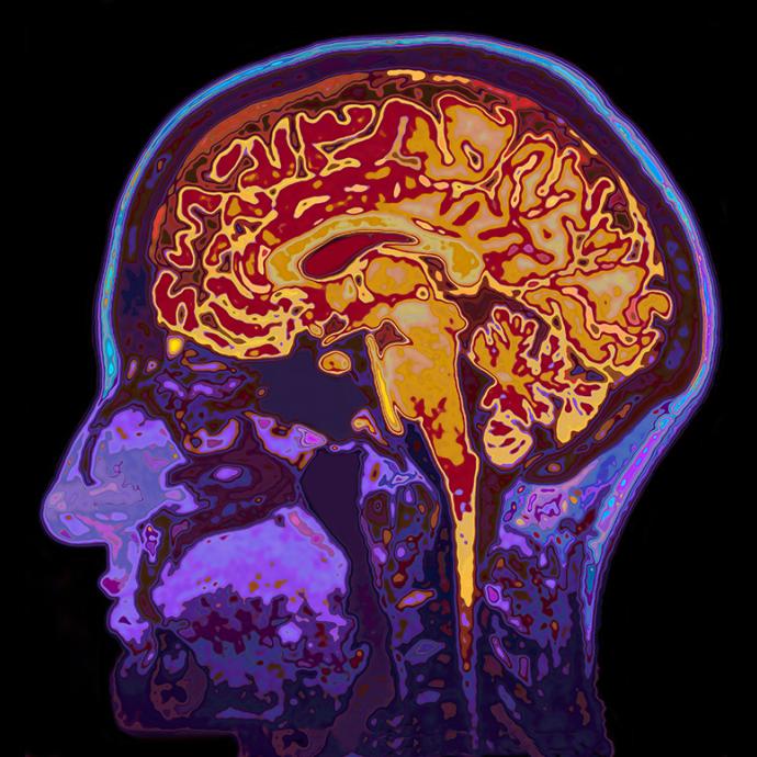 MRI image showing a brain