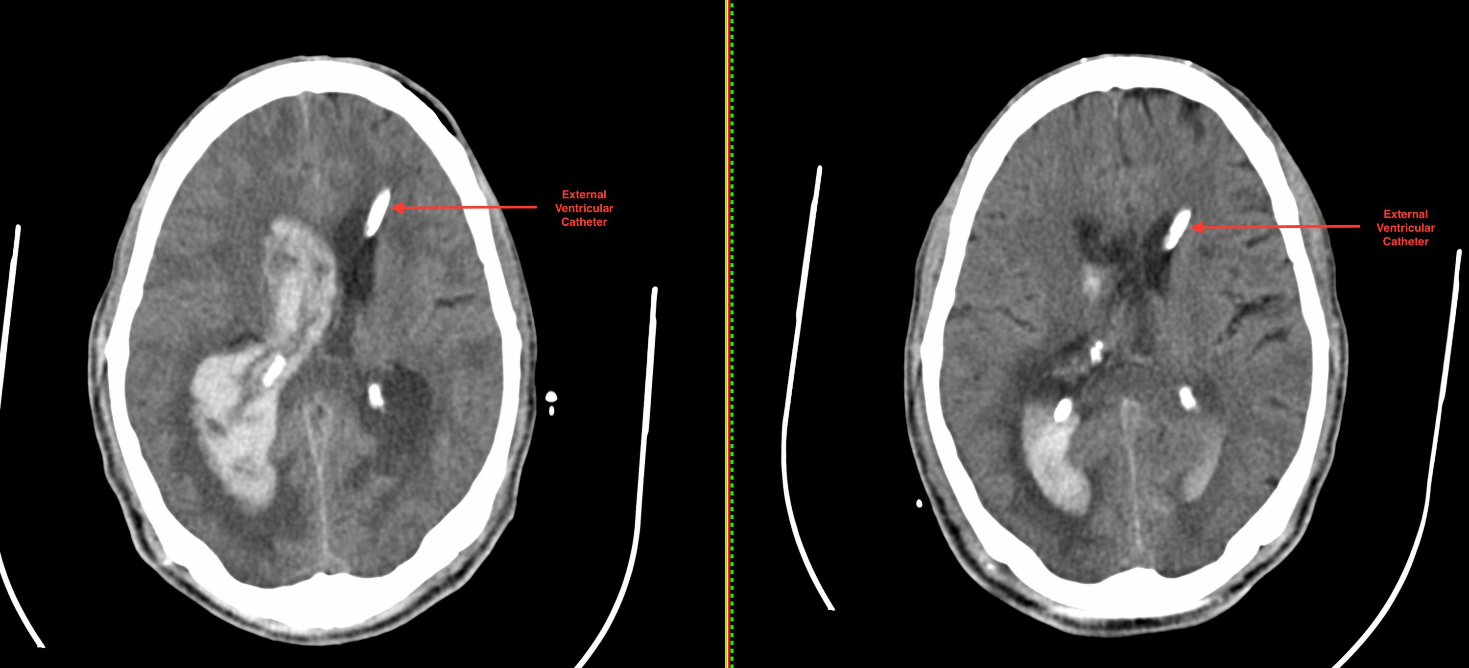 What are the recommended medical treatments for a hemorrhagic stroke?